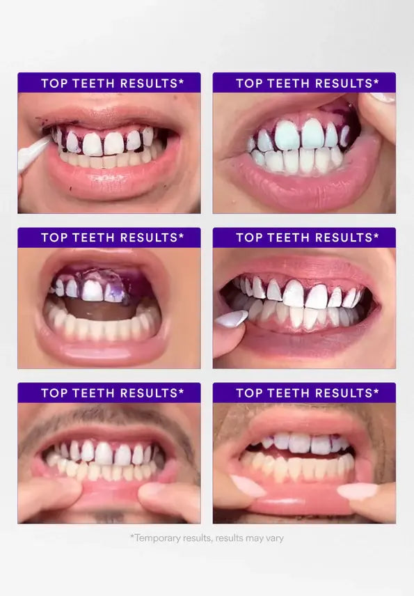 Transform Your Smile with V34 Whitening Strips - 1 Pack for Radiant Results