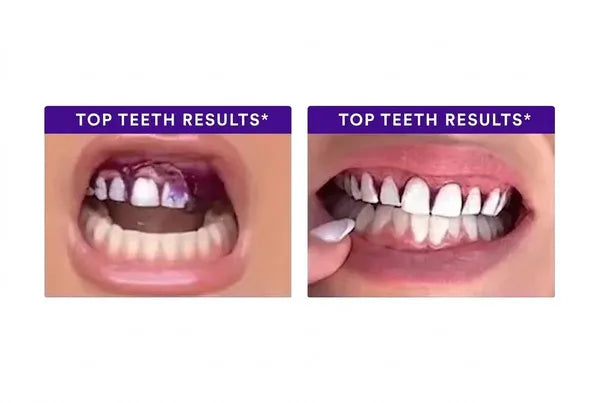 Before-and-after image 1 of teeth using V34 strips