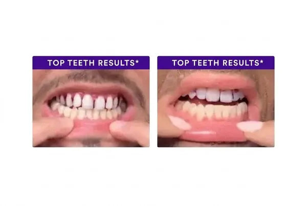 Before-and-after image 2 of teeth using V34 strips