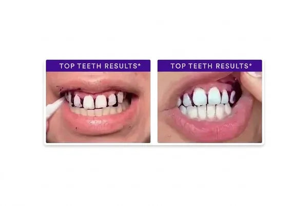 Before-and-after image 3 of teeth using V34 strips
